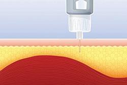 Insulin injection technique can improve glucose control