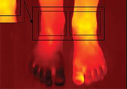 Thermography detects joint inflammation 