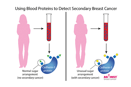 Test to detect breast cancer spread