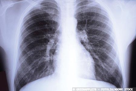 Award-winning lung cancer service