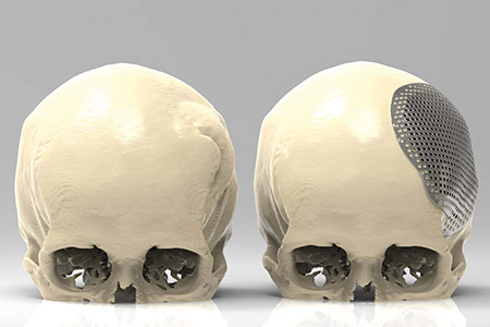 3D printing innovation in medical implants