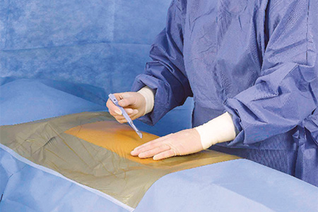 How surgical drapes help to reduce SSI risk
