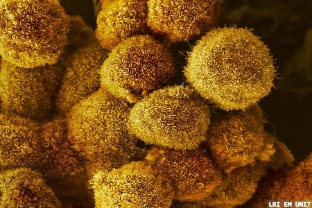 Pancreatic cancer clinical trials to take place  