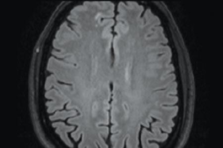 MRI scans help spot persistent HIV in brain