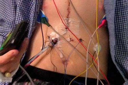 Wireless technology used to monitor health