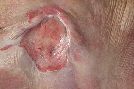 Tackling the burden of pressure ulcers