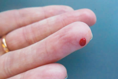 Research highlights improvements in cardiovascular risk for women developing Type 2 diabetes 