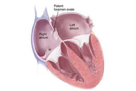 Young people among those set to benefit from lifesaving heart op as part of the NHS Long Term Plan