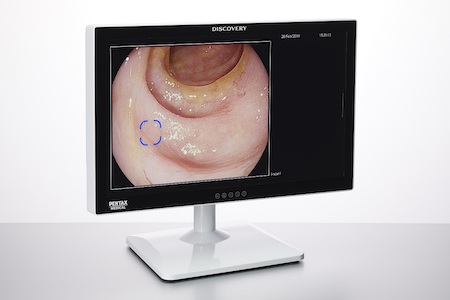 AI-assisted polyp detector