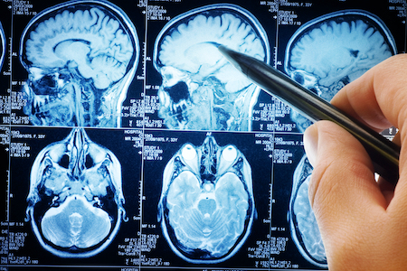 Brain complications found in some patients with severe COVID-19