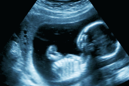 Type 1 diabetes could begin in the womb