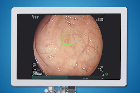 London Clinic uses artificial intelligence to advance colonoscopy