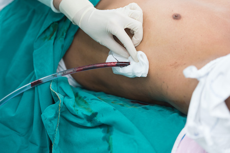 Warning issued over chest drain incidents
