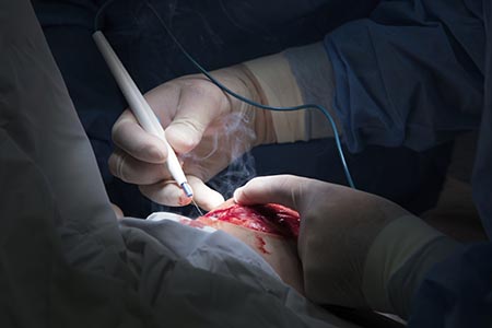 Eliminating the hazards of surgical plume