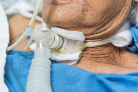 Early tracheotomy helps patients avoid ventilator-associated pneumonia