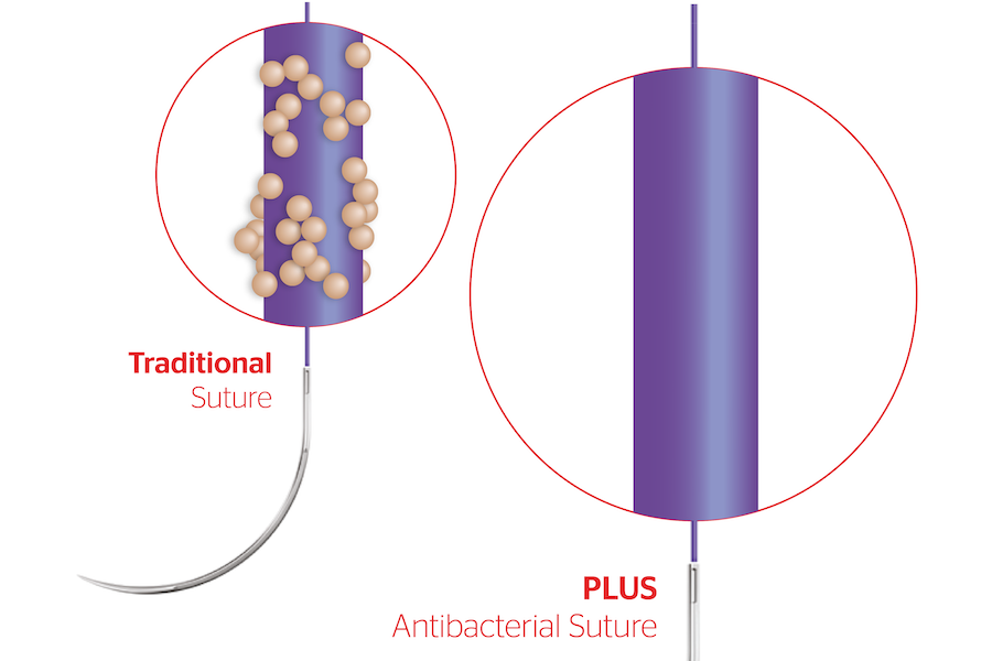 NICE recommends adoption of antibacterial sutures