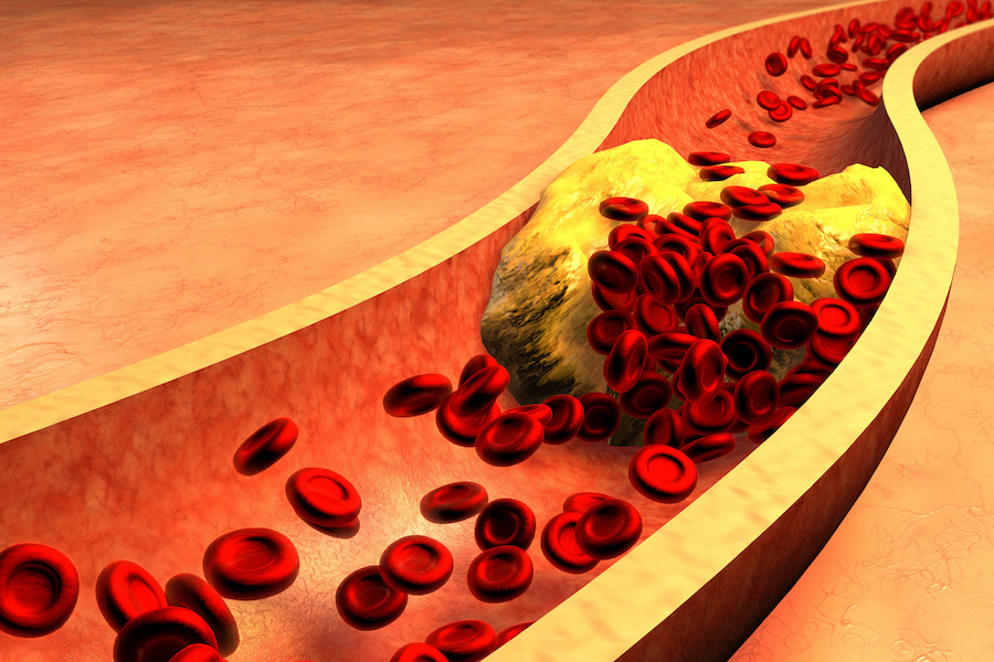 NHS cholesterol-busting jab to save thousands of lives