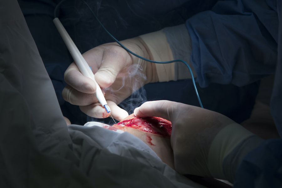 Is surgical smoke the most overlooked hazard in operating theatres?