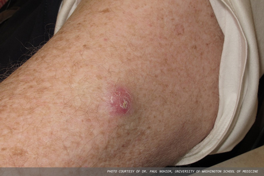 Patients with rare skin cancer face 40% recurrence rate