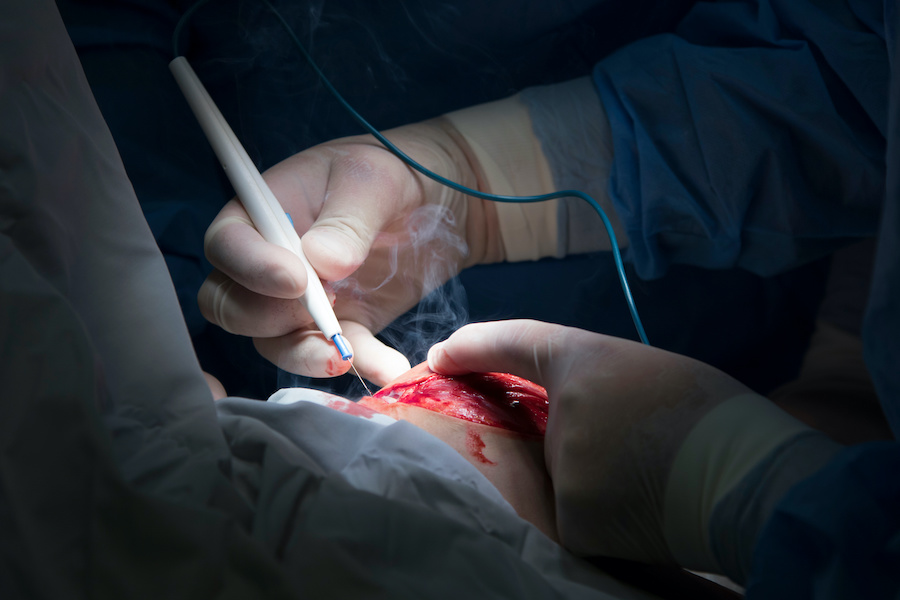 Report reveals underestimated risks of surgical plume