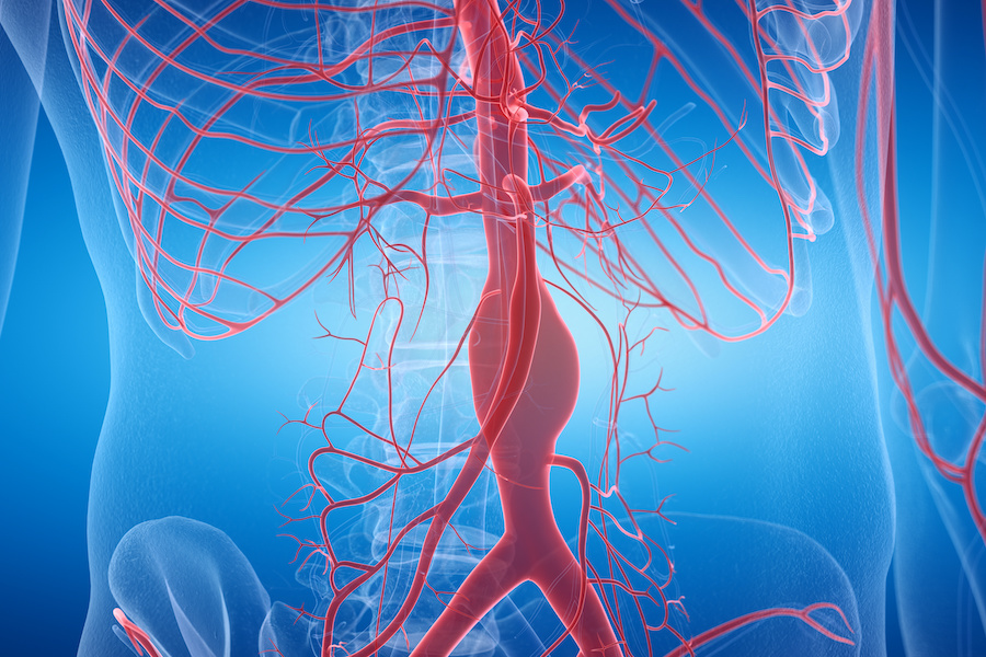 Women more likely to die or need repeat surgery after AAA repair