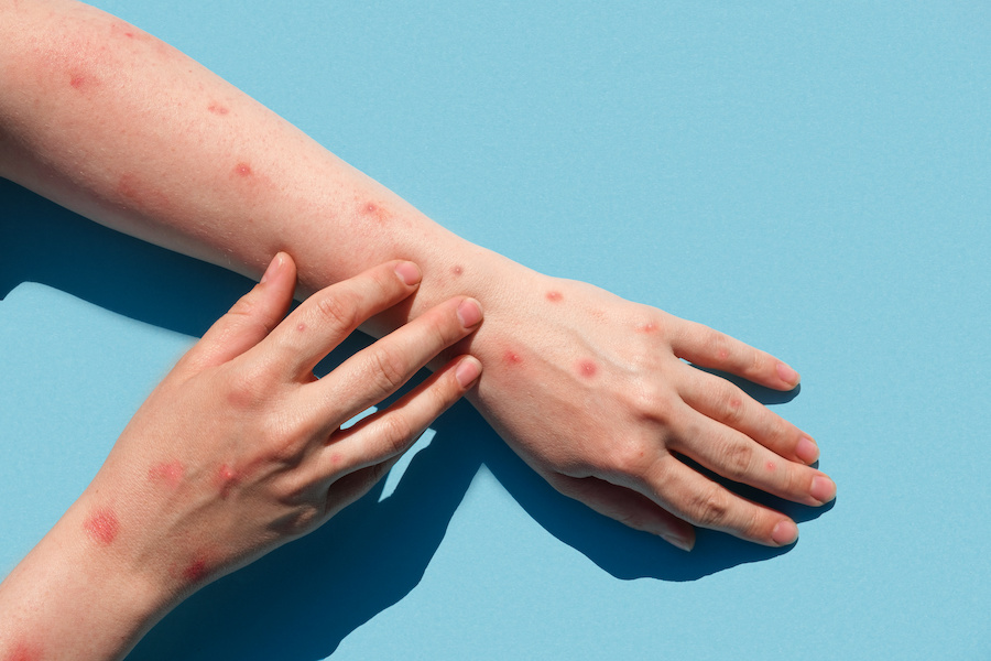 Monkeypox content made free to clinicians worldwide