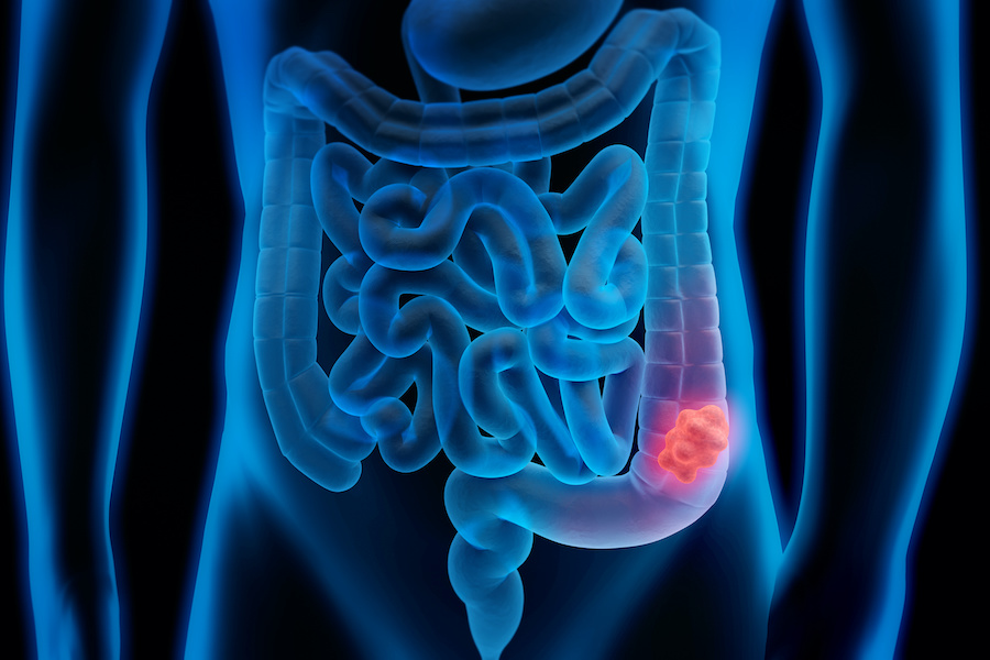 NHS expands lifesaving home testing kits for bowel cancer