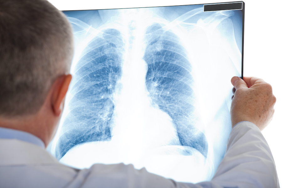 New targeted lung cancer screening programme on the horizon