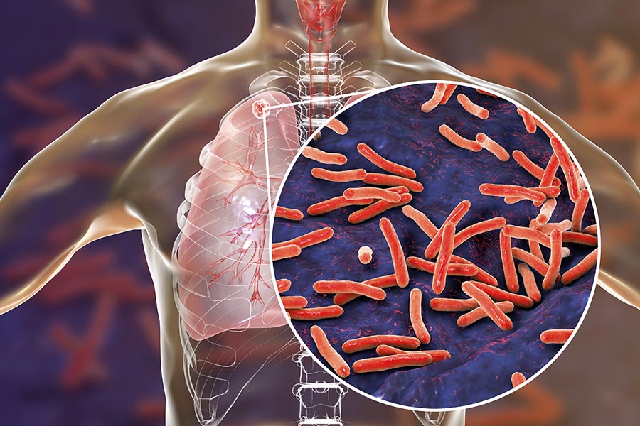 Tuberculosis response recovering from pandemic but accelerated efforts needed to meet new targets