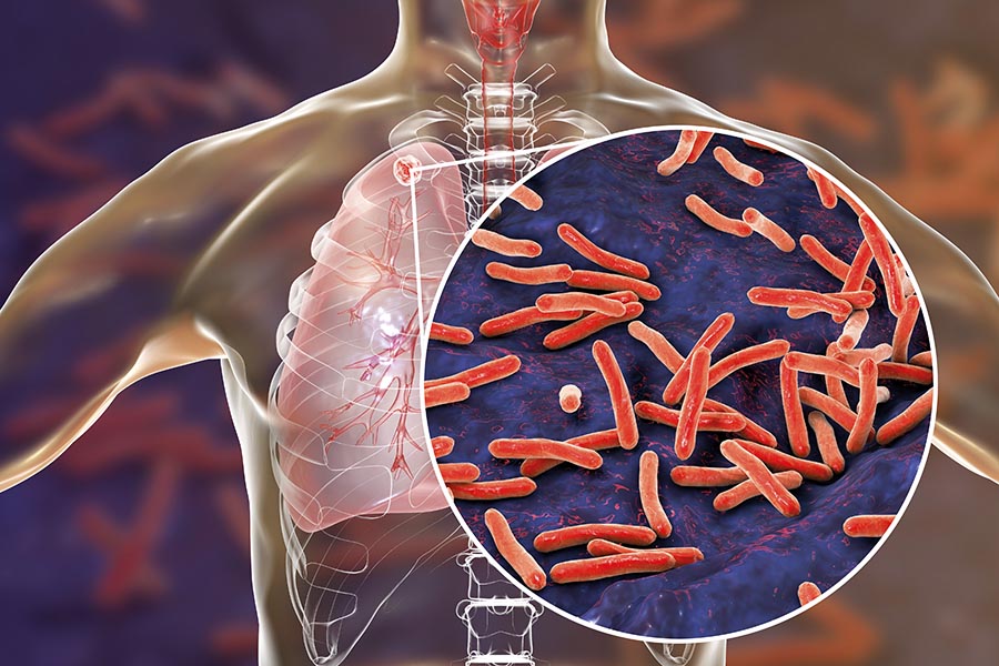 Scientists close in on blood test to stop spread of tuberculosis