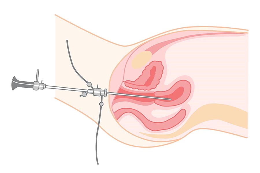 Women report experiences of extreme pain during hysteroscopy
