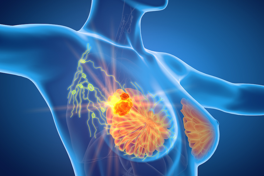 Trial to let women use breast diagnostic clinics through NHS App