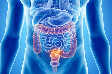Bowel cancer risk 'could be reduced with an extra glass of milk'