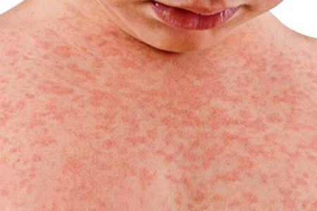 Measles on the rise again in Europe