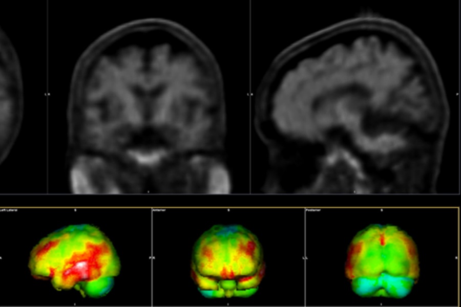Siemens Healthineers co-leads EU Alzheimer’s disease care initiative