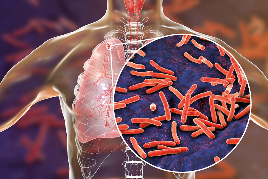 Shorter treatment regimens are safe options for preventing active tuberculosis