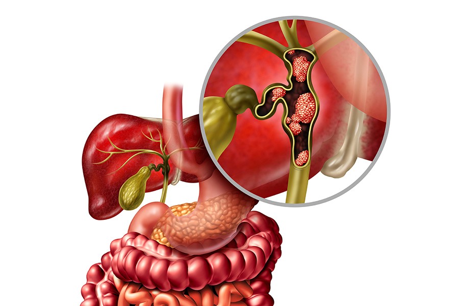 New life-extending treatment given the green light for people with rare form of bile duct cancer