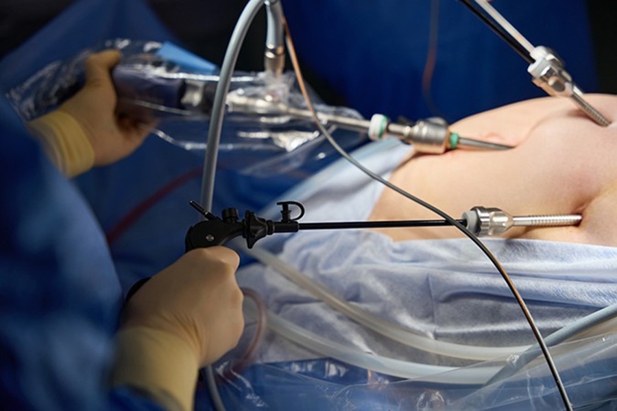 Gut microbiota plays a role in metabolic health after bariatric surgery