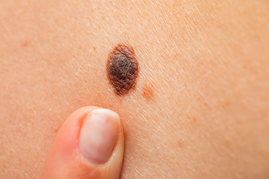 Healix Health enhances its skin cancer screening service with Circle Health Group 